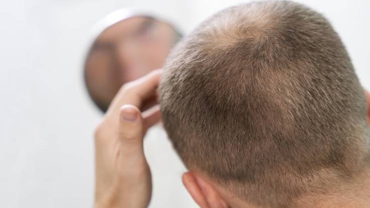 Alopezia, udazkenean berpizten den beldurra